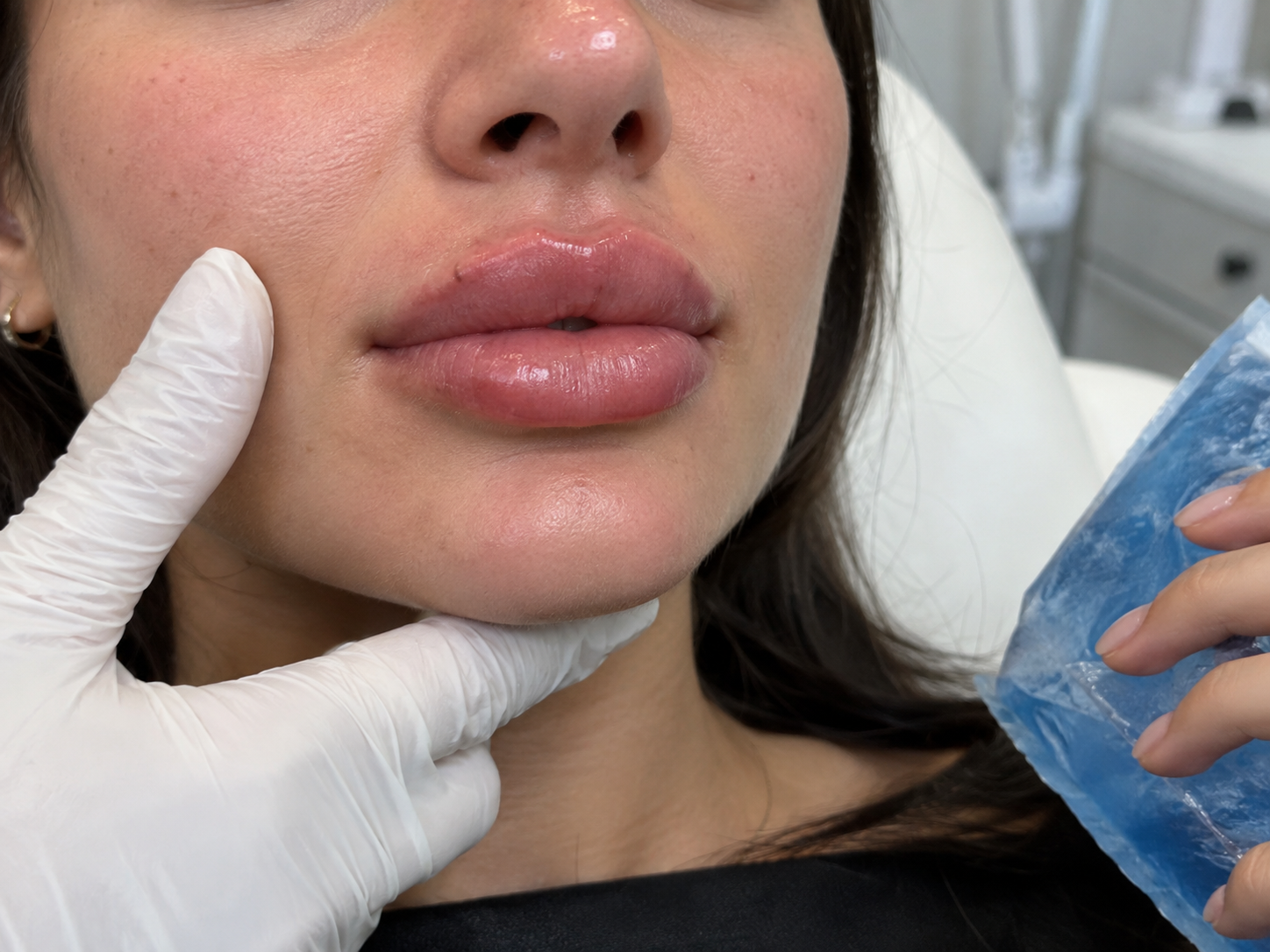 Ácido hialurónico en labios: duración, recuperación y cuidados